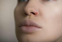 Herpesvirus in de neus herpesvirus neus